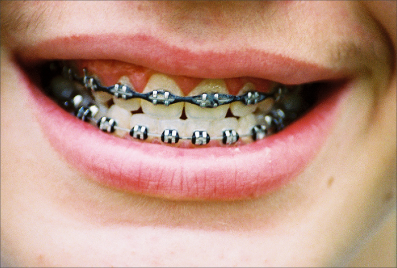 braces